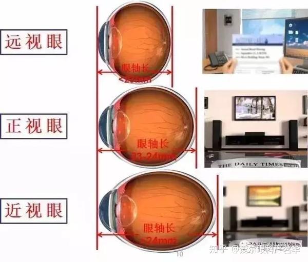 相同角膜曲率下的不同眼轴长度表现出的屈光不正状态