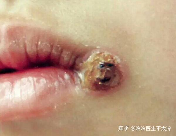 戴避孕套会感染梅毒吗?