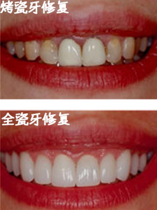 全瓷牙烤瓷牙no一字之差差别很大