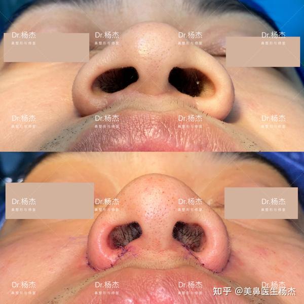 鼻翼缩小内切外切效果怎么样能切多少毫米