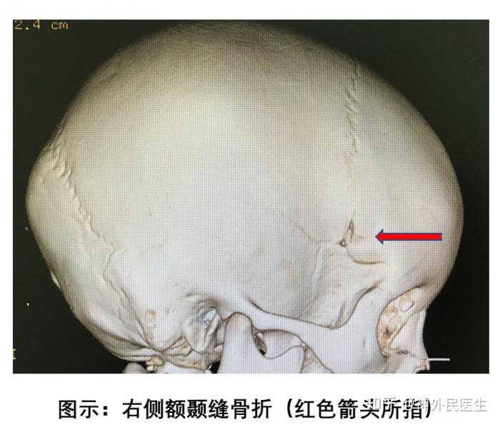 颅骨线性骨折怎么办