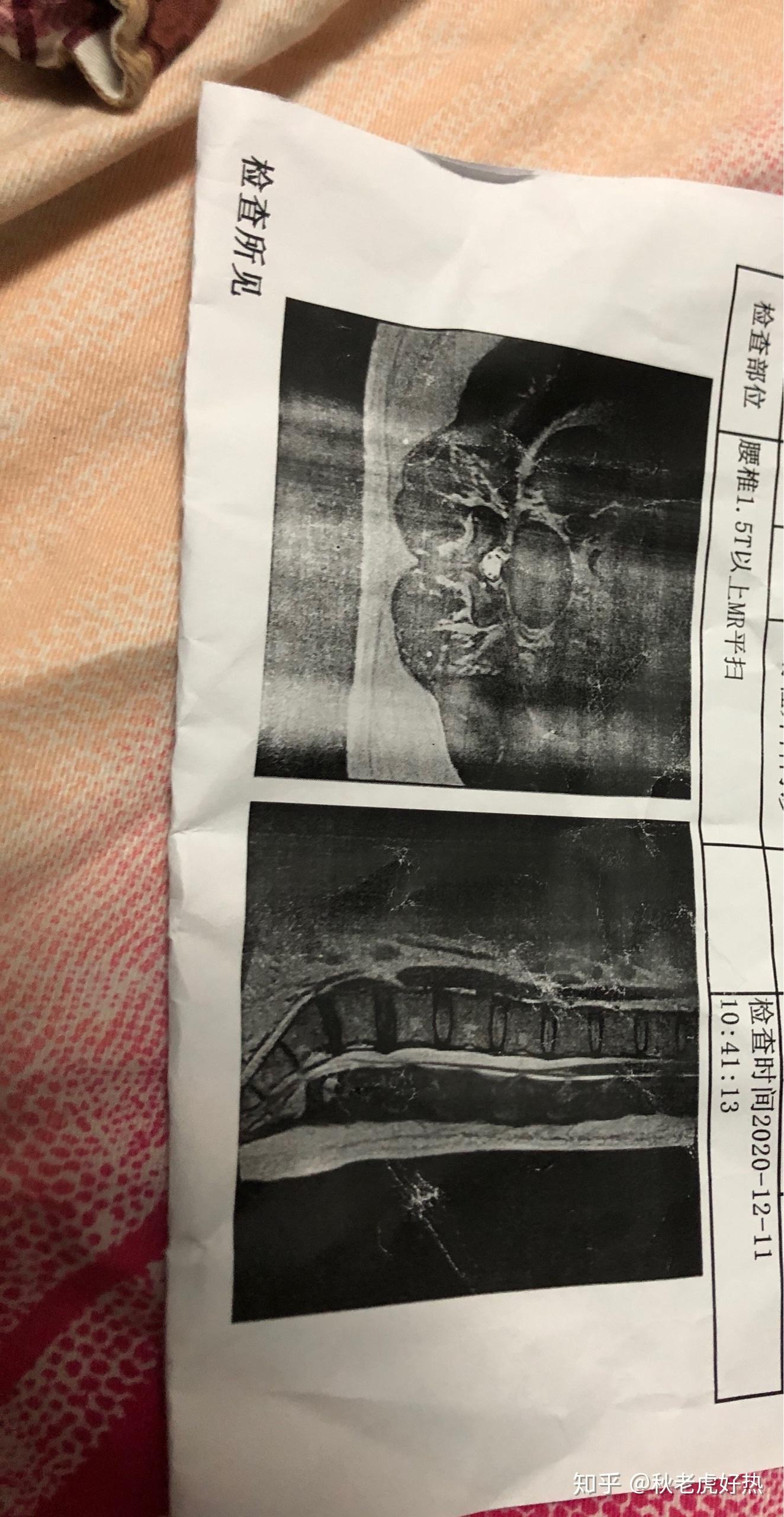 求大神帮我看看腰椎片子有没有压迫神经