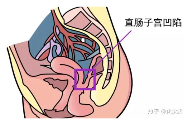 盆腔积液 - 知乎