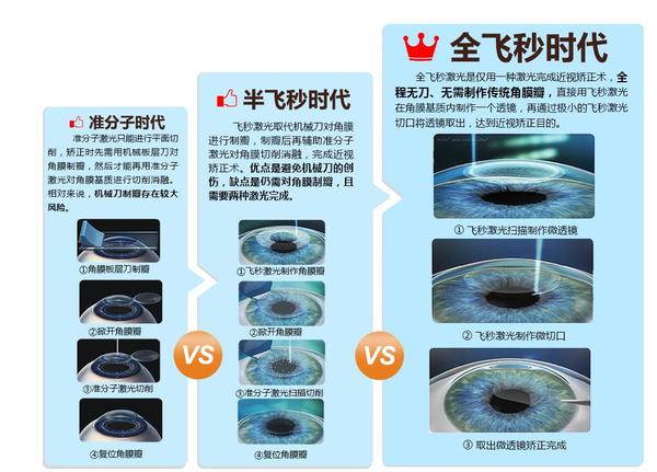 成都做近视手术准分子激光和飞秒选择哪个比较好有没有后遗症