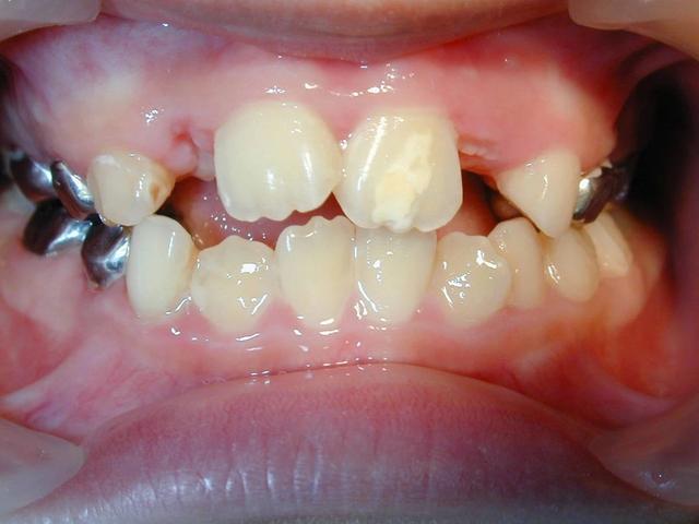 及时治疗;此外,乳牙的慢性根尖炎症及牙齿外伤也会影响恒牙釉质钙化