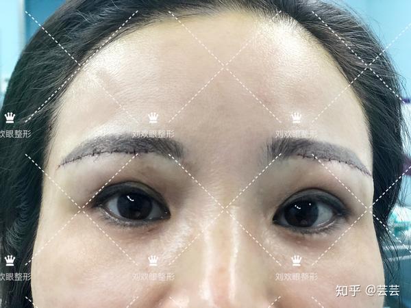 方案:眼窝脂肪胶填充,眉下切口及眼尾提升术