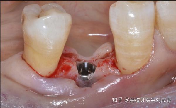 郑州瑞士iti亲水种植牙是怎样的体验主任医师或副主任医师做种植牙是