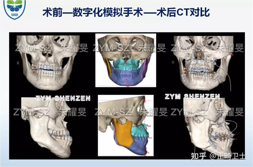 朱耀旻博士数字化正颌手术案例分享