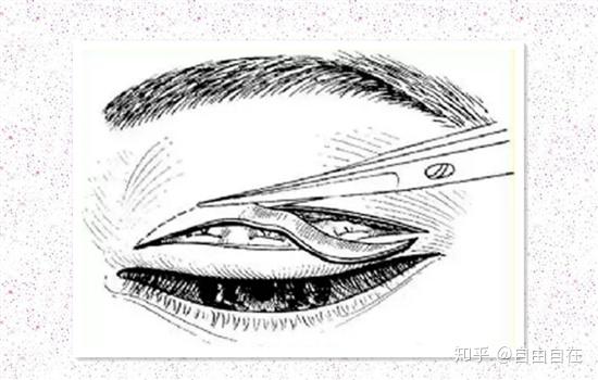 结膜囊涂抗生素眼膏单眼包扎.