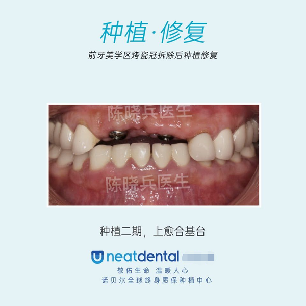 广州种植牙案例:前牙美学区烤瓷冠拆除后牙齿种植修复
