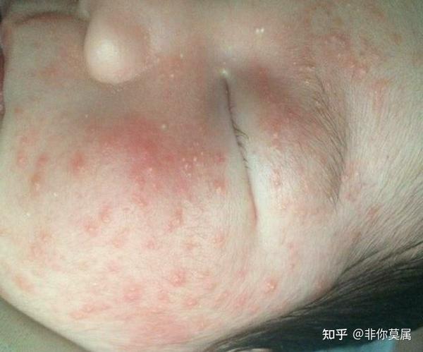脂溢性皮炎,婴儿痤疮,婴儿湿疹如何辨别?