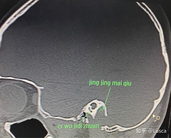 可以看到右侧乳突气房与乙状窦壁相通,未见憩室,颈静脉球位置高于耳蜗