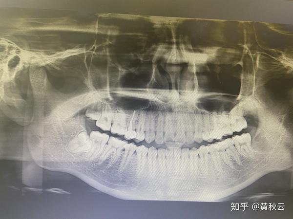 这样看智齿有没有顶坏大牙