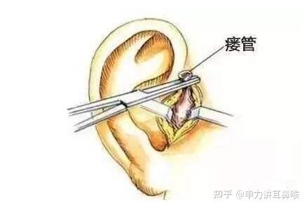 孩子耳朵长小孔是怎么回事耳科高丹红医生解释