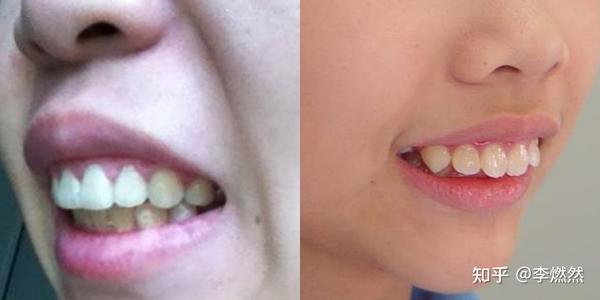左:骨性凸嘴,右:牙性凸嘴