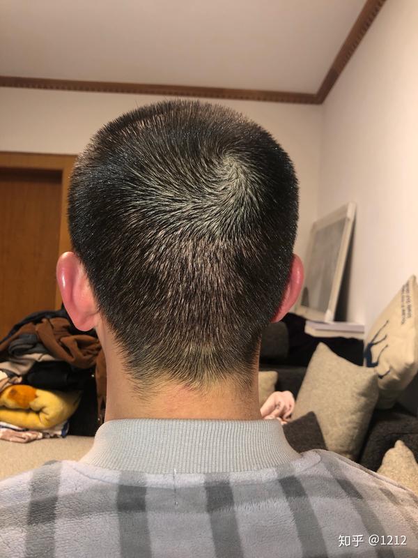 一月十七日,后脑勺已经好了很多,头发也长长了,貌似进入脱落期了.