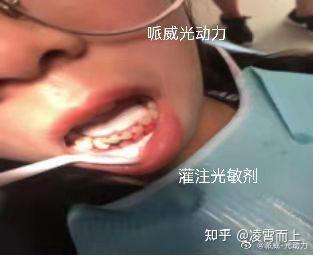 口腔科普#发生在身边的牙龈炎