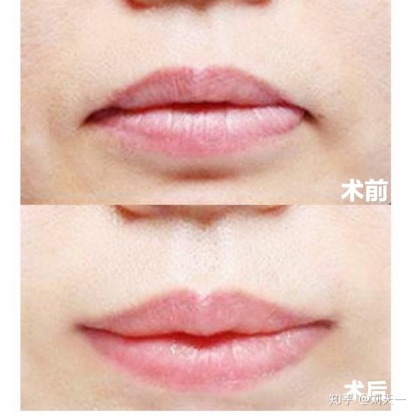 (图二)微笑唇可以有效的改善先天或者后天的嘴角下垂
