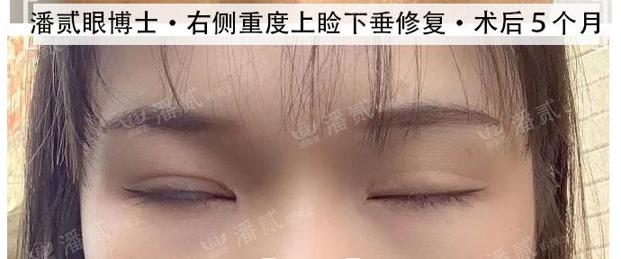 重度上睑下垂术后为什么闭不上眼睛闭眼不全怎么护理好