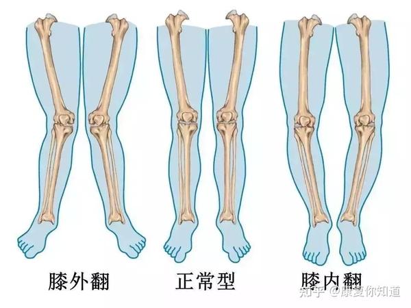 "o"型腿,"x"型腿详解及矫正方案