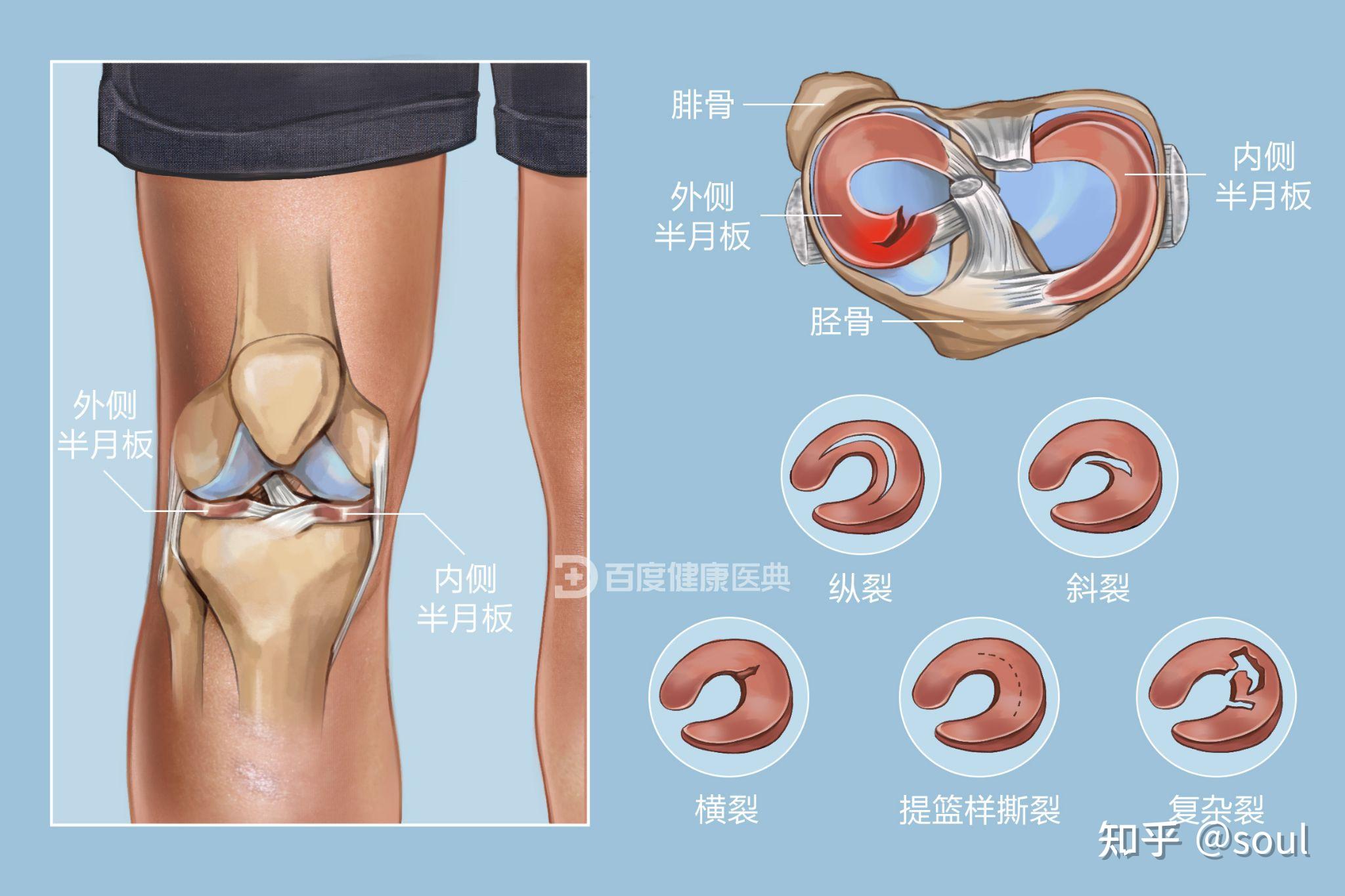 半月板一度二度损伤,还能参加今年的体考吗?