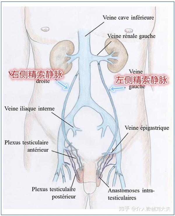 双侧精索静脉解剖示意图