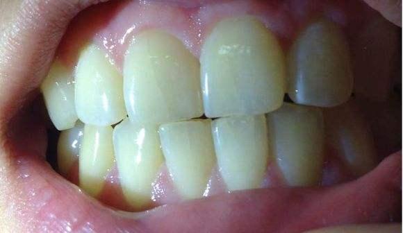 有牙隐裂是否能洗牙