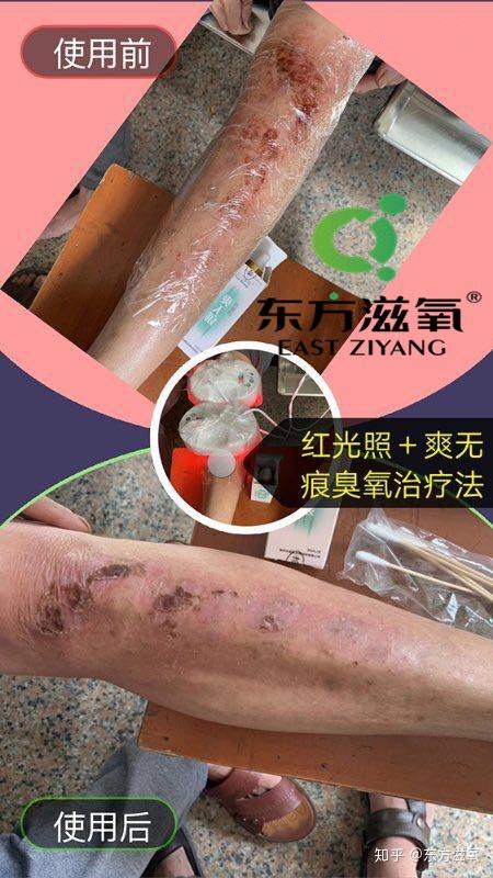 【患者信息】 患者 男 【患者症状】 伤口感觉很痒,并发现发炎了