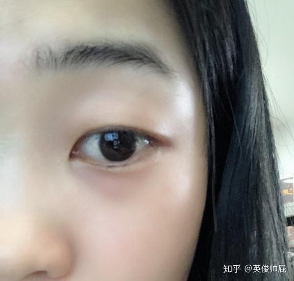割双眼皮是一种什么样的体验?
