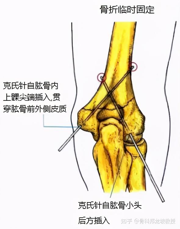 仅累及干骺端,未累及关节面的肱骨远端骨折,可以通过石膏外固定等非