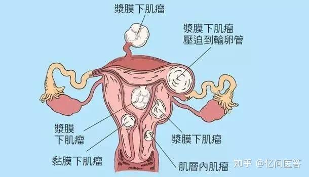 子宫肌瘤分类有两种方式,一种是根据子宫肌瘤发生的部位分为子宫体