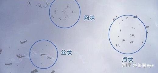 01,什么是飞蚊症?