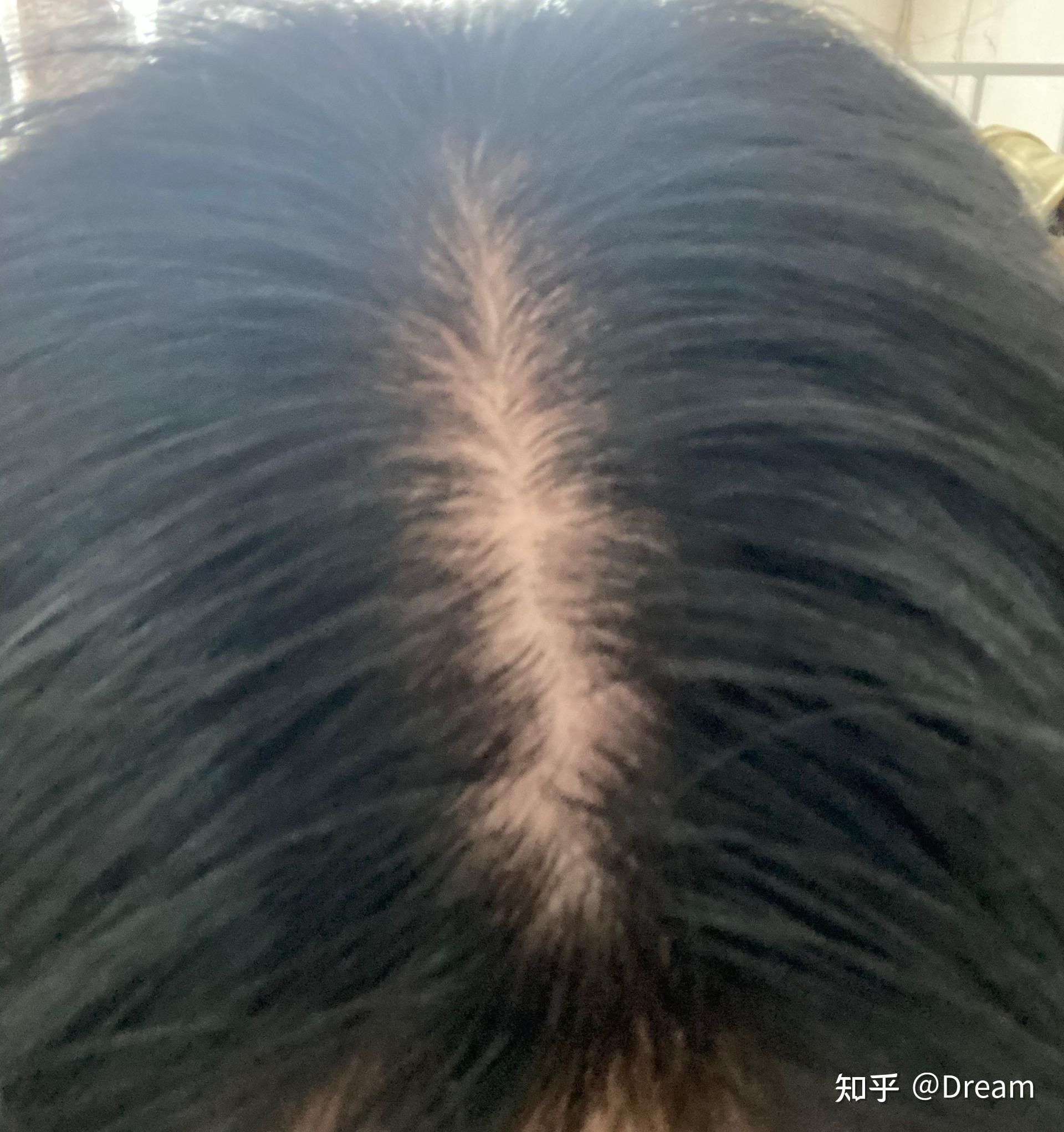 女生头顶脱发怎么办?
