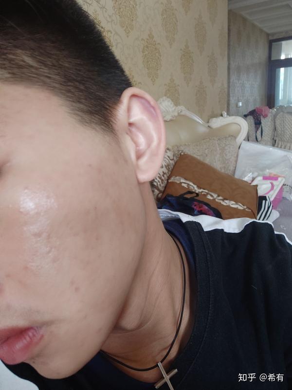 阿达帕林加壬二酸亲身实测