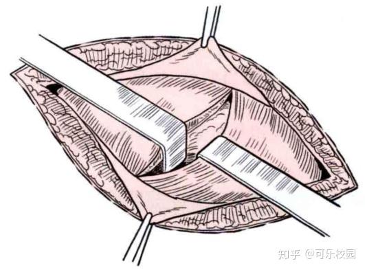 一般切除法 一般取麦氏切口(图1).