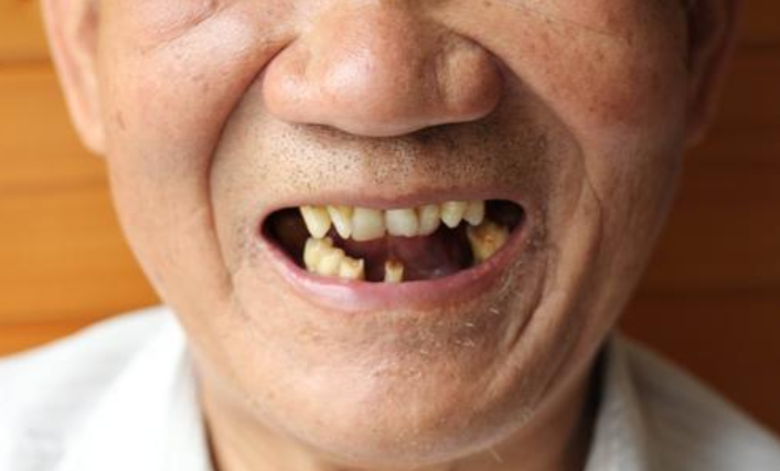 老人牙齿越来越差多数是这3个误区造成的