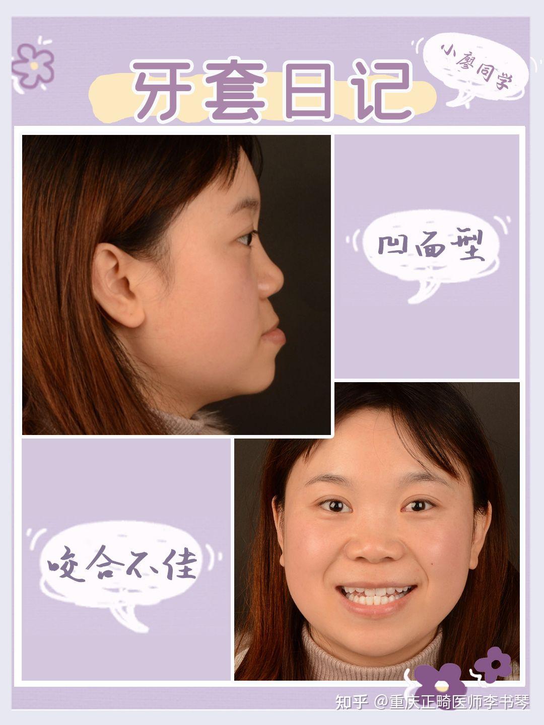 牙套日记之小廖同学①地包天初诊