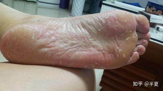 脚气(学名足癣),系真菌感染引起,其皮肤损害往往是先单侧(即单脚)