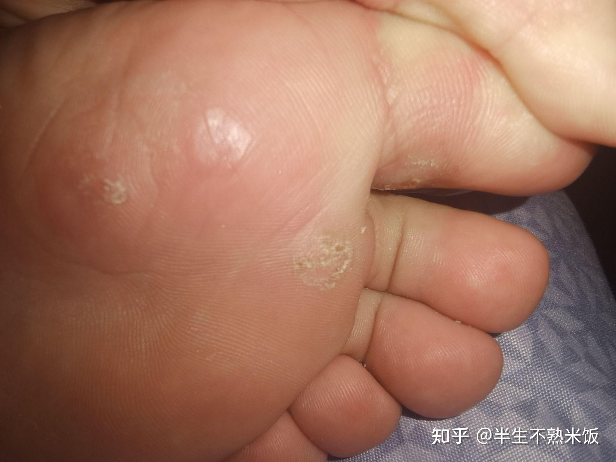 两年的治疗跖疣记录持续更新