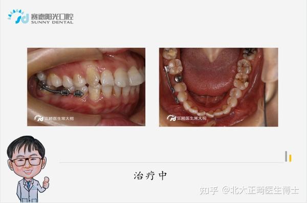 郑州牙齿矫正医生常大桐:隐适美拔牙矫治牙不齐,改善患者笑容