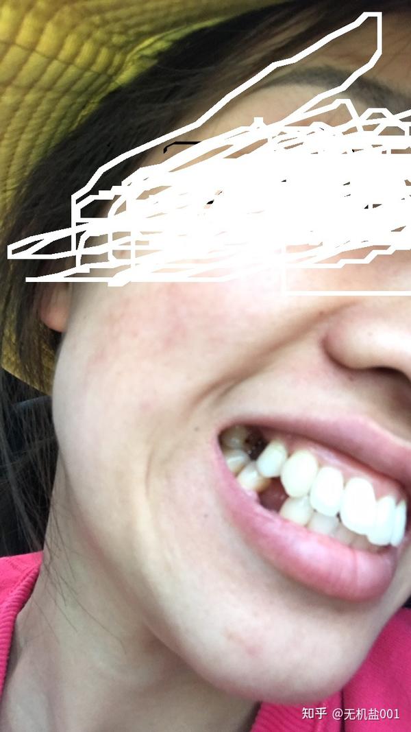 30宝妈龅牙牙龈萎缩牙缝变大后矫正历险记超级害怕牙套脸黑三角法令纹