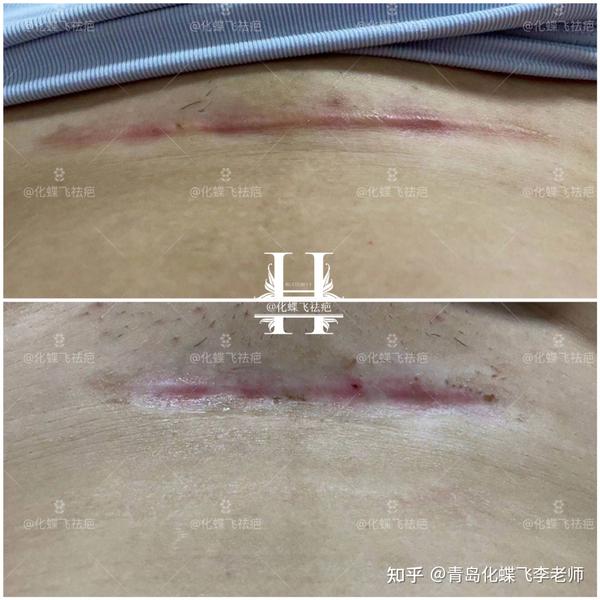 涂中药#祛疤,涂药不认真 依然效果杠杠滴 这次掉痂,基本都平了
