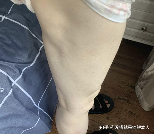 上海大腿吸脂失败反馈|谨慎种草!