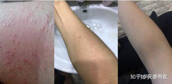 【干货分享】有湿疹不要怕,一篇文章就够用,教你辨别湿疹,治疗湿疹