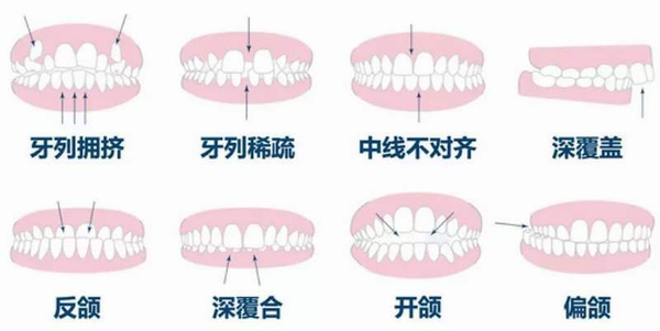 厦门牙齿矫正:整牙会"牙套脸"?还会牙齿松动?关于正畸