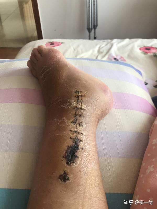(又一波小高能,伤口结痂,以及掉皮) 术后一个月去复查,大夫说恢复的