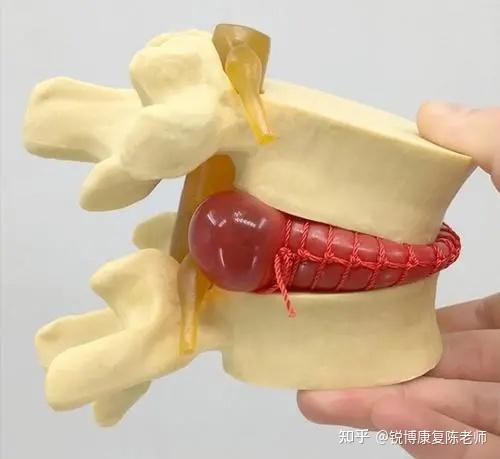 锐博康复腿麻脚麻就是腰椎间盘突出别傻了