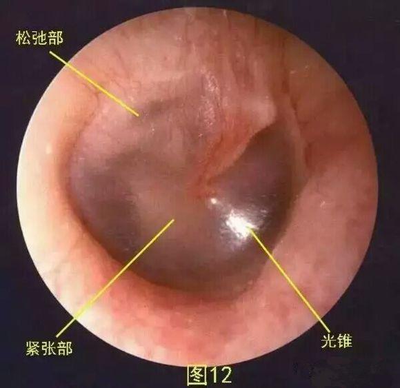 中耳炎需要手术,但不愿手术或不能手术该注意哪些?