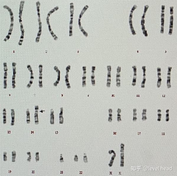 一条14号染色体和一条21号染色体罗伯逊易位核型图