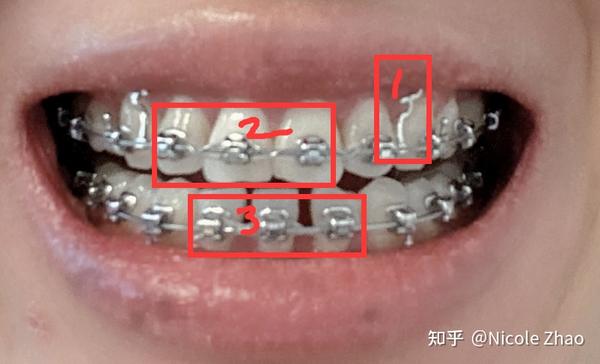 3就是下排牙齿,依然是橡皮链挪门牙的位置,逐步收缝.